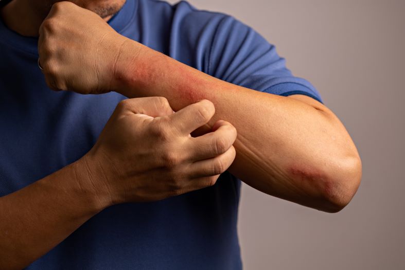 Person klør arm med utslett av atopisk eksem